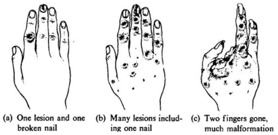 Drawings of hands of early radiologists showing increasing degrees of tissue damage