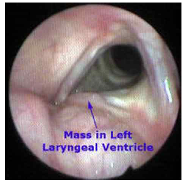 Laryngeal Ventricle 에 종양이 진행된 경우