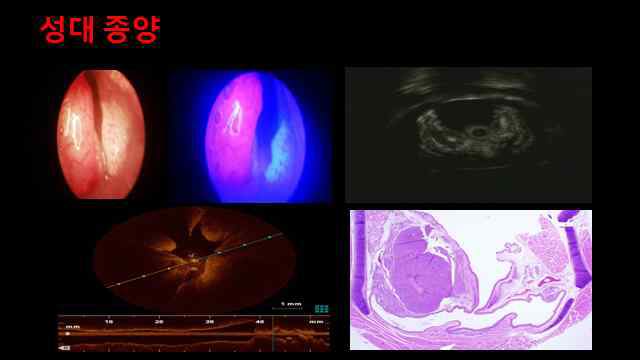 성대 종양 모델 개발