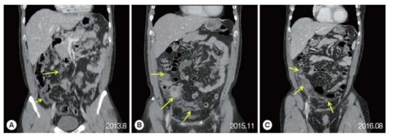 복부폐흡충증(Peritoneal paragonimiasis) 환자의 CT사진