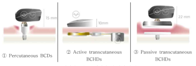 이식형골전도보청기의 세 가지 유형