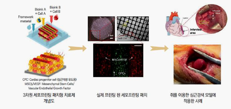 패치형 심근경색 줄기세포 치료제 개발