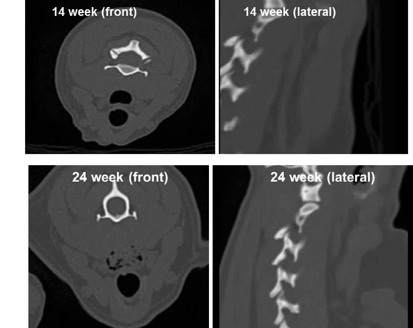 3D 바이오프린팅 기관(trachea) 이식 3, 6개월 후 기관 내시경 및 CT 분석