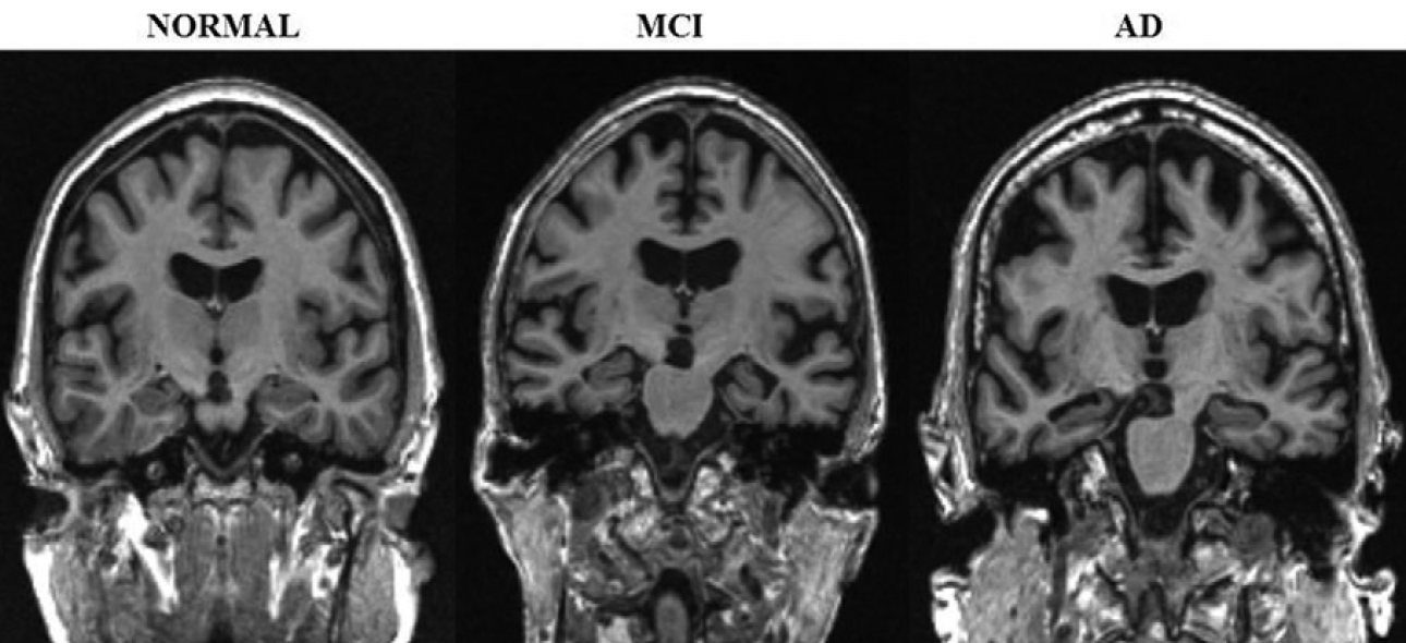 Atrophy and clinical stage of AD (Jack CR, et al. Radiology 2012;263:344-361)