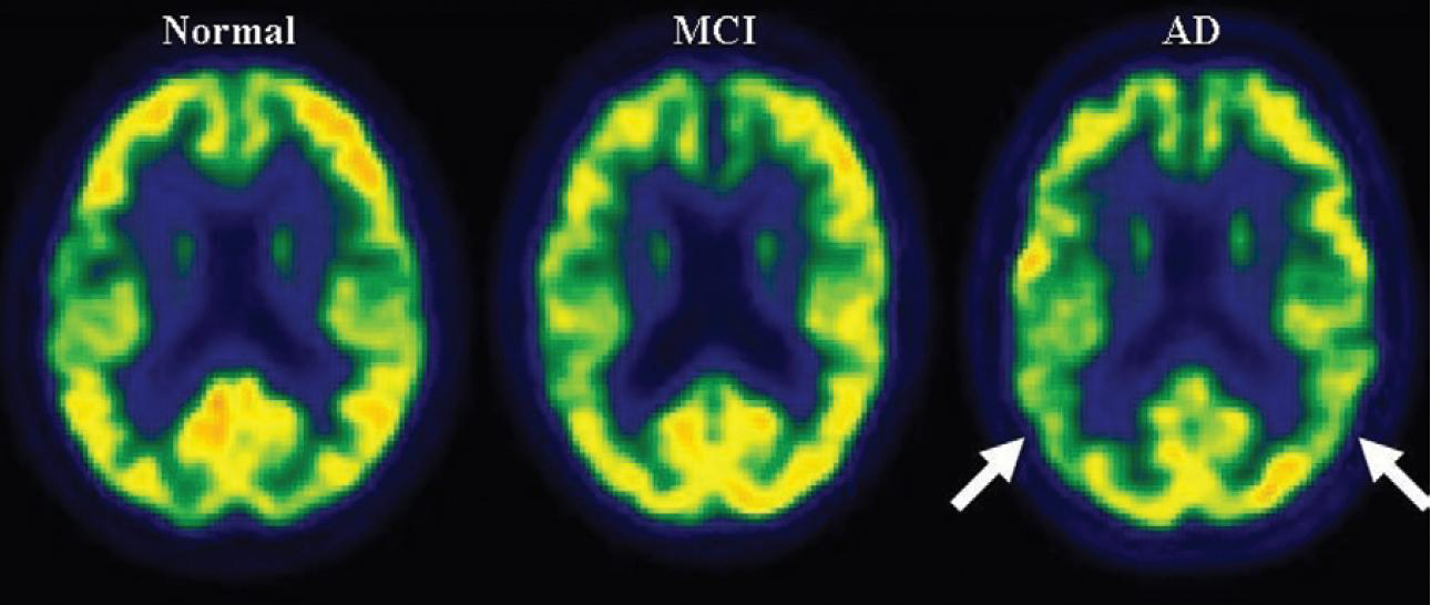 Typical FDG PET uptake pattern in AD (Jack CR, et al. Radiology 2012;263:344-361)