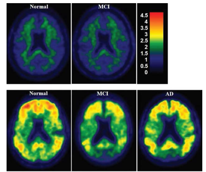 Amyloid imaging spectrum (Jack CR, et al. Radiology 2012;263:344-361)