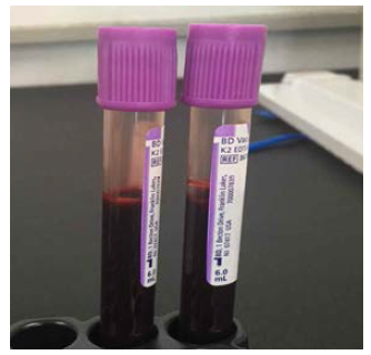 EDTA 용기에 채취한 혈액검체(예시)