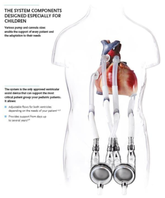 의료용보조순환장치 인체 삽입 모형도 출처 : Berlin Heart, “EXCOR Pediatric VAD par Excellence” 설명집