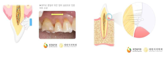 치경부 마모증의 원인, 잘못된 칫솔질(왼쪽)과 과도한 교합력