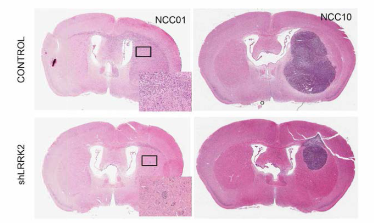 LRRK2를 과발현된 세포주를 이용한 PDX 모델의 종양형성능력 검증