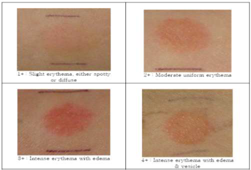 Clinical standard photographs of visual assessment for human patch test