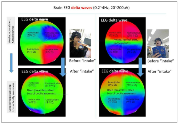 미강추출액 섭취 전후 EEG delta “사고인지능력 저하” 상태의 0.2-4 hz 파형