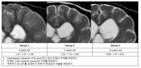 대뇌 피질의 두께 및 인접한 고랑 두께 측정