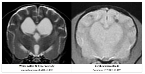 WHM 소견 및 Cerebral microbleeds 소견
