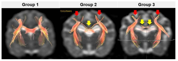 Tractography를 이용한 주관적 평가. 노화가 진행될수록 양측 대뇌 반구를 이어주는 communicating projection의 명확한 감소 (노란색), 일부 백질 끝부분 (corona radiata)의 두께 명확한 감소 (빨간색)이 확인
