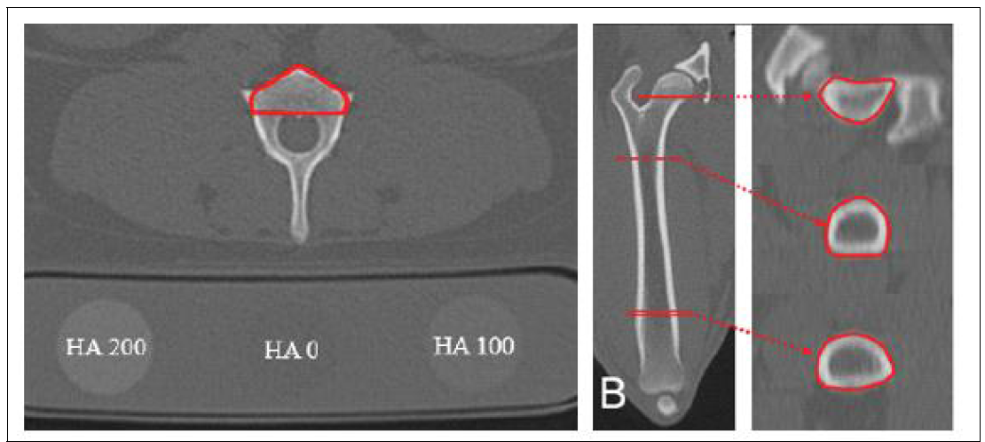 CT를 이용한 골밀도 측정. 척추뼈 (좌)와 대퇴골 (우)에서의 골밀도 측정
