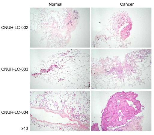 인체유래 폐암 검체의 H&E 염색 사진