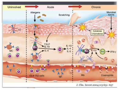 피부의 면역과민반응 메커니즘