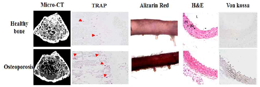 뼈의 항상성 파괴는 혈관석회화와 밀접한 연관성을 가지고 있음 고용량 비타민 D 투여 (아래) 시 파골세포의 수(TRAP 염색)와 골흡수가 증가하여 해면골이 감소됨 (Micro-CT). 골감소와 상반되게 혈관에서는 병적인 미네랄이 침착되어 혈관석회화가 형성됨 (Alizarin red, H&E, Von kossa)