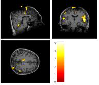 Activated brain areas to mechanical pain stimulation