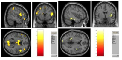 Activated brain areas for hand pain (left) and foot pain (right) condition