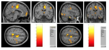 Brain activations after meditation program in pain versus no-pain condition