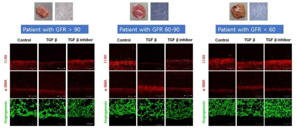 GFR에 따른 환자 세명 유래 신섬유화 장기칩의 염색지표 비교