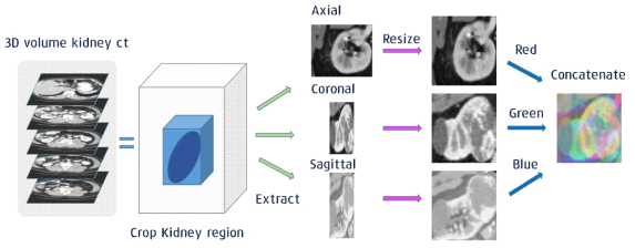 신장 abnormality 판별 모델에서 사용한 Axial/ Coronal/ Sagittal 영상으로 구성된 3 channel 훈련데이터 건설 과정