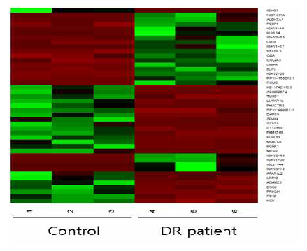 RNA 시퀀싱 분석으로 확인된 질환자-정상인에서 차별발현 되는 유전자들의 heatmap
