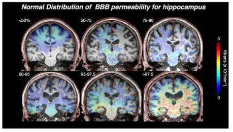 Normative distribution of BBB permeability for hippocampus and other brain regions (Submitted to Korean J Radiol)