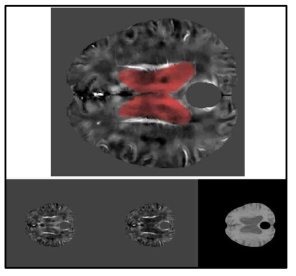 SPM을 이용하여 lateral ventricle의 logical matrix를 얻고 이를 통해 mask를 이용 normalized QSM 영상 개발함