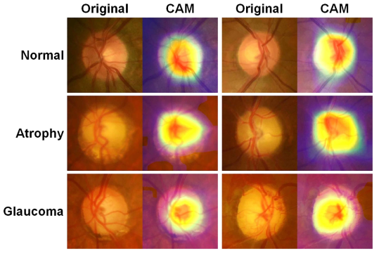 분류 모델에서의 class activation map(CAM) 결과. (A) Normal, (B) NGON, (C) GON