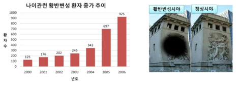 한국의 연도별 황반변성 환자 증가현황 및 황반변성 예