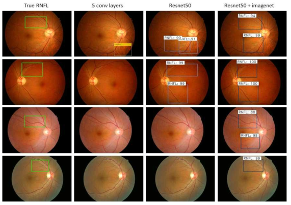 5 Convolutional Layer와 ResNet50, ResNet50+전이학습 모델에서의 망막신경섬유층 결손 자동 검출 결과 비교 (좌측부터 Ground Turth, 5 Convolutional Layer, ResNet50, ResNet50+전이학습 모델)