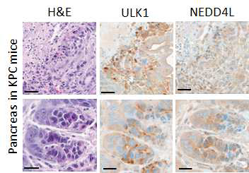 KPC마우스의 췌장에서 PDAC병변부위의 ULK1과 NEDD4L 발현분석