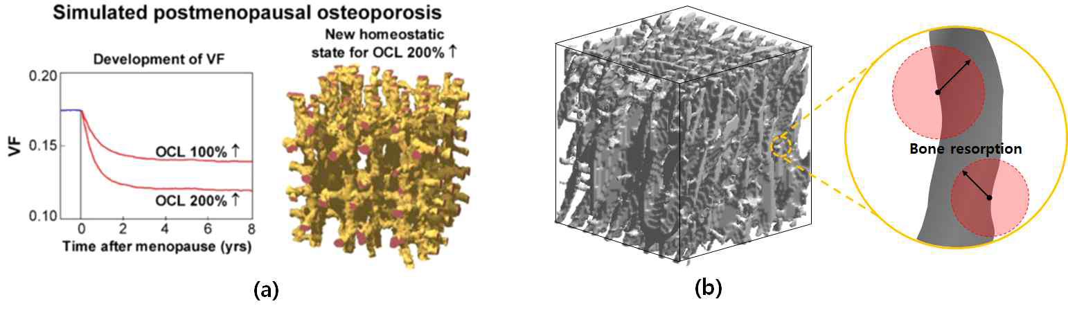 골다공증을 반영한 전산모사: (a) 참고문헌의 사례(Ruimerman et al., 2005); (b) 골흡수 현상에 대한 확률론적 접근법 개념