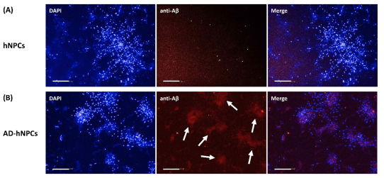 인간 뇌세포를 활용한 알츠하이머 모델에서 진단지표인 Aβ plaque 확인 (A) 알츠하이머 유전자들이 없는 hNPCs로부터 분화된 뇌세포 대조군. (B) APPSL 및 PSEN1을 발현하는 AD-hNPCs로부터 분화된 뇌세포 및 Aβ plaque (화살표). (A, B) anti-Aβ 항체로 immunostaining하였으며 specific visualization 을 위해 GFP 및 RFP와 형광 파장이 중복되지 않는 Cy5 계열의 secondary antibody를 사용하였다. 세포 염색 시료는 30 μm 두께로 z-stack 촬영하였다 (scale bar: 200 μm)