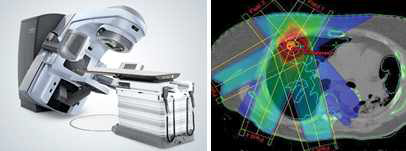 치료용 방사선 조사기 (좌)와 정상조직의 영향을 최소화하기 위한 치료 계획 (우)