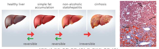 간암 진행 과정 (좌) 및 지방간 조직 (우)