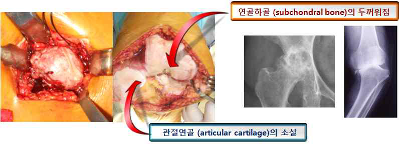 골관절염의 임상적 소견