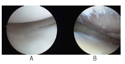 사람의 정상무릎관절(A)과 광범위한 연골 손상이 있는 무릎관절(B)의 관절경 사진