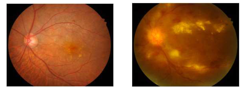 초기 당뇨 망막병증 환자의 안저(좌), 중증 당뇨 망막병증 환자의 안저(우)