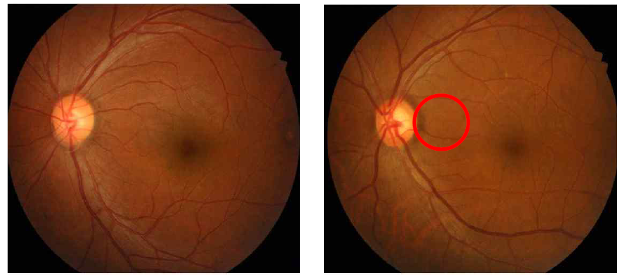 정상안의 안저(좌)와 녹내장성 시신경 변화가 있는 안저(우)