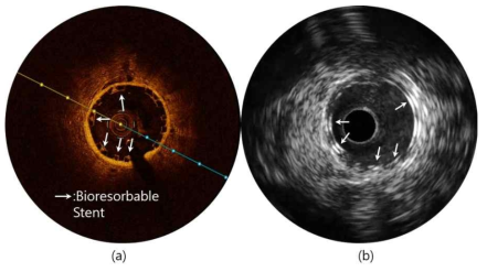 (a)OCT와 (b)혈관 초음파로 보여주는 생 분해형 스텐트가 삽입된 관상 동맥의 단면. 흰색 화살표는 스텐트가 위치한 곳을 가리키며, 초음파 영상에서 스텐트는 두 개의 층으로 이루어 져 있음