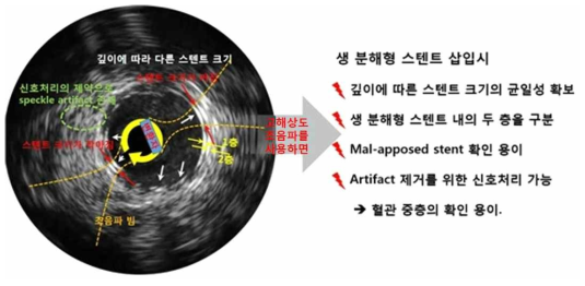 고해상도 혈관 초음파를 사용하여 생분해형 스텐트를 잘 보여줄 수 있음