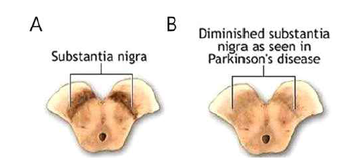 파킨슨씨 병. A. 정상적인 사람의 흑질체 모습. B. 파킨슨병에 의해 흑색이 사라진 모습, 보통 도파민 생성세포의 60-80%가 사멸하면 파킨슨병 증상이 나타남