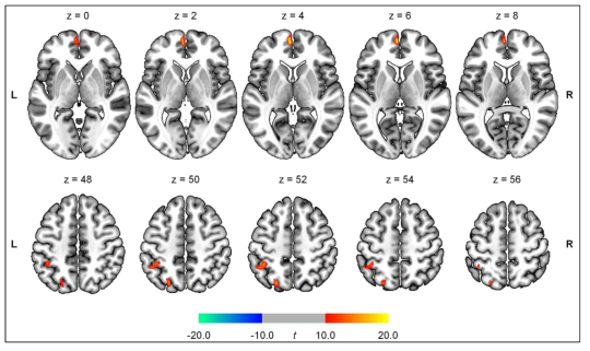 파킨슨병 환자에서 12개월의 tDCS 치료 적용 이후 뇌혈류의 변화