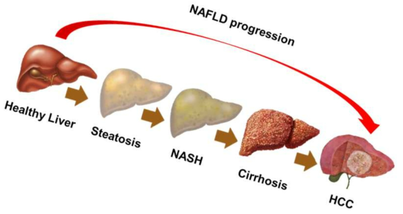 비알코올성 지방간염은 단순 지방간부터 비가역적 병변인 간경화 및 간암까지 다양한 병변을 유발함