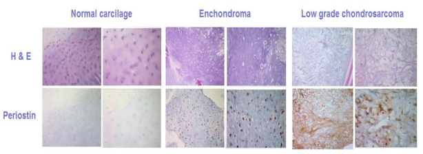정상연골조직, 양성연골종양, 저등급 악성연골종양에서의 Periostin 발현 양상