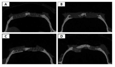 micro-CT를 통해 scaffold에 신생뼈가 자라있음을 단면으로 확인한 결과 사진